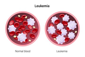 Leukemia: The Little-Understood Blood Cancer Killing Hundreds of Thousands Every Year