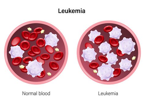 Leukemia: The Little-Understood Blood Cancer Killing Hundreds of Thousands Every Year